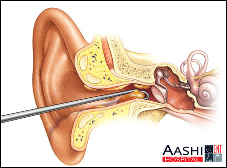 Earwax Removal, Best ENT hospital in Ahmedabad