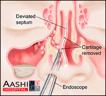 Endoscopic sinus surgery