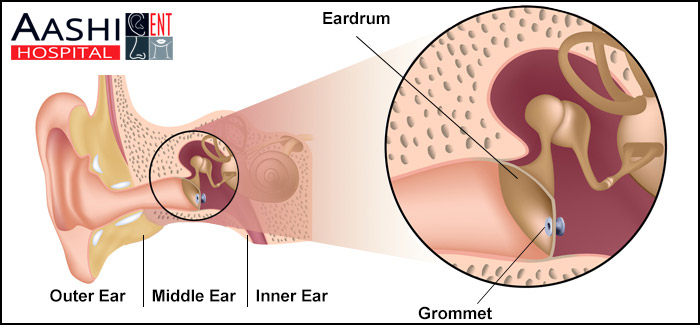 Gromments, Throat surgery in Ahmedabad