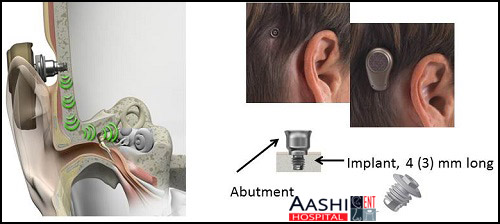 Hearing AIDS, Ear surgery in Ahmedabad