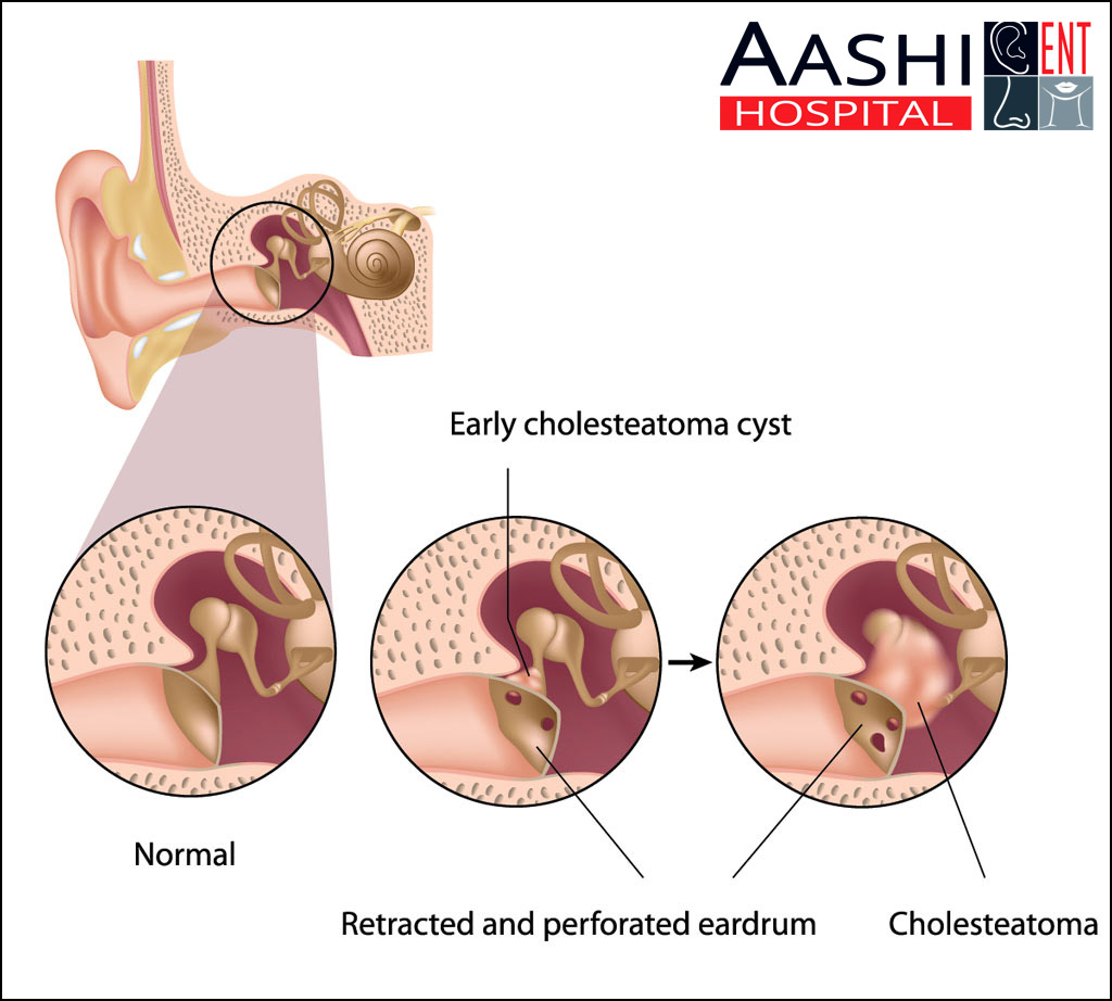 Mastoidectomy, Throat surgery in Ahmedabad MASTOIDECTOMY