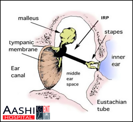 Ossiculoplasty - ENT Surgery Specialist