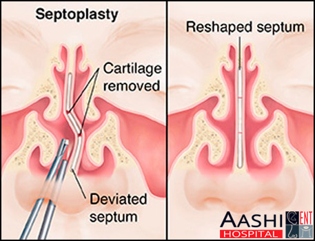 Septoplasty & Submucosal Research