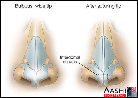 Septorhinoplasty, Nose and sinus surgery