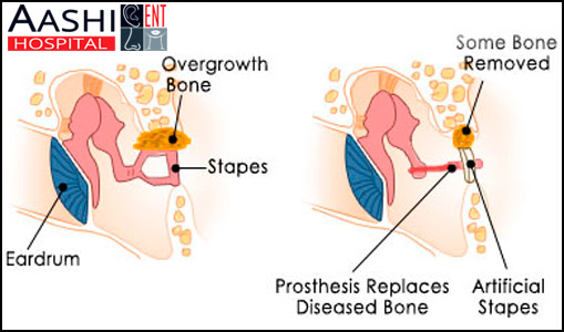 Stapedectomy, Throat surgery in Ahmedabad STAPEDECTOMY