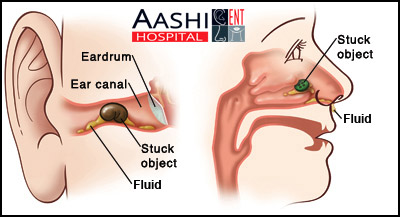 Nose and Sinus Surgery