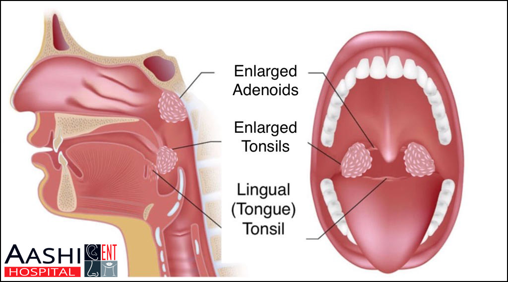 Tonsils and Adenoids, Eardrum repair operation TONSILS-AND-ADENOIDS