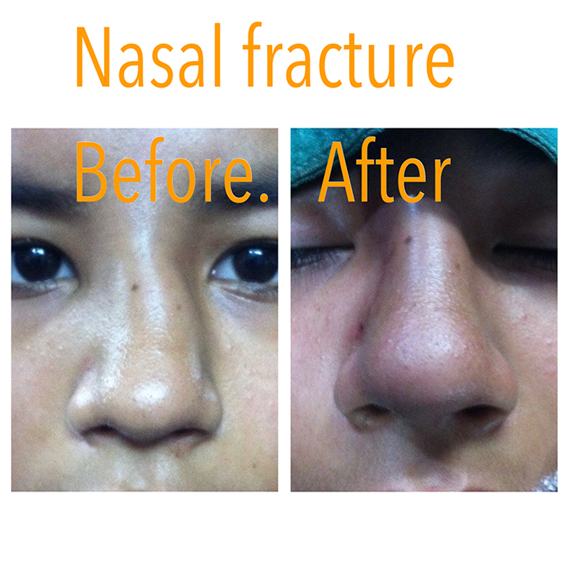 Nasal Before After Nasal Before After