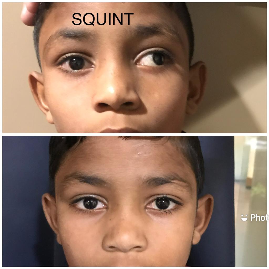 Squint Surgery Specialist in Ahmedabad | Eye Squint Specialist in Ahmedabad