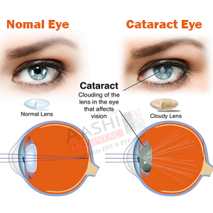 Best Cataract surgery in Ahmedabad